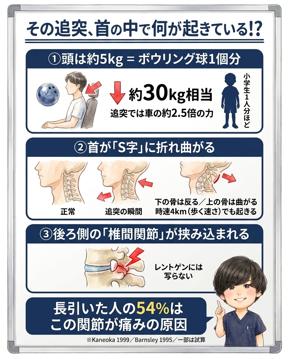 追突で頭に車の約2.5倍の力がかかり首がS字に折れ曲がって椎間関節が挟み込まれる仕組みを示した図解